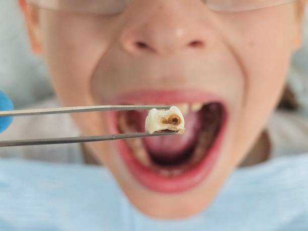 Best Emergency Dental Extractions in Warr Acres, OK
